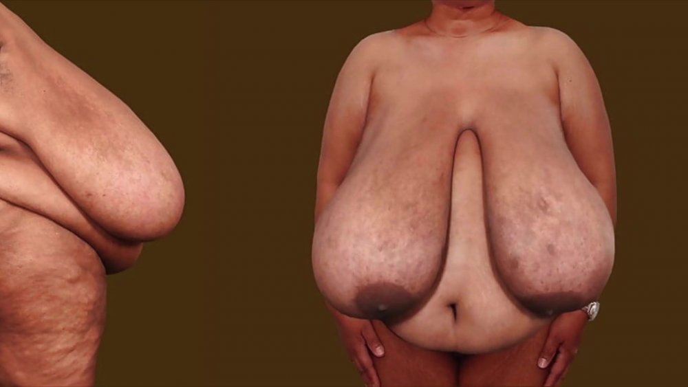 SSBBW Macomastia Tits
