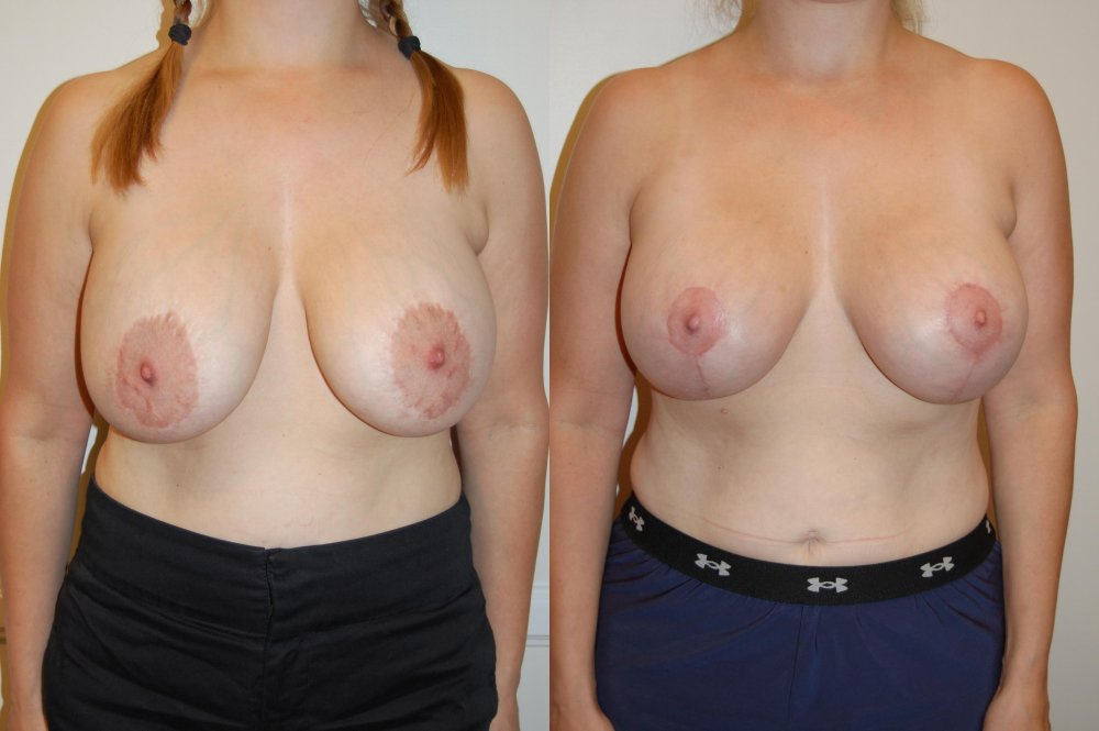 No hollow between breasts