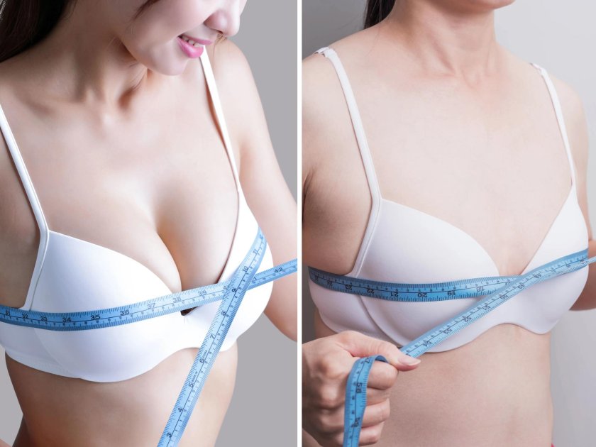 Direct breast